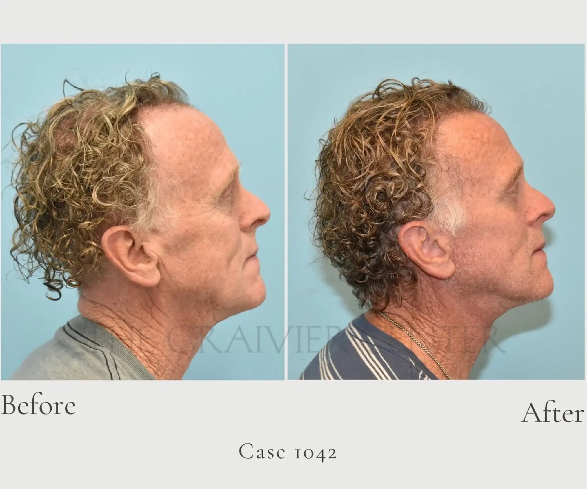 Case 1042 Facelift and Lower Eye lid 4